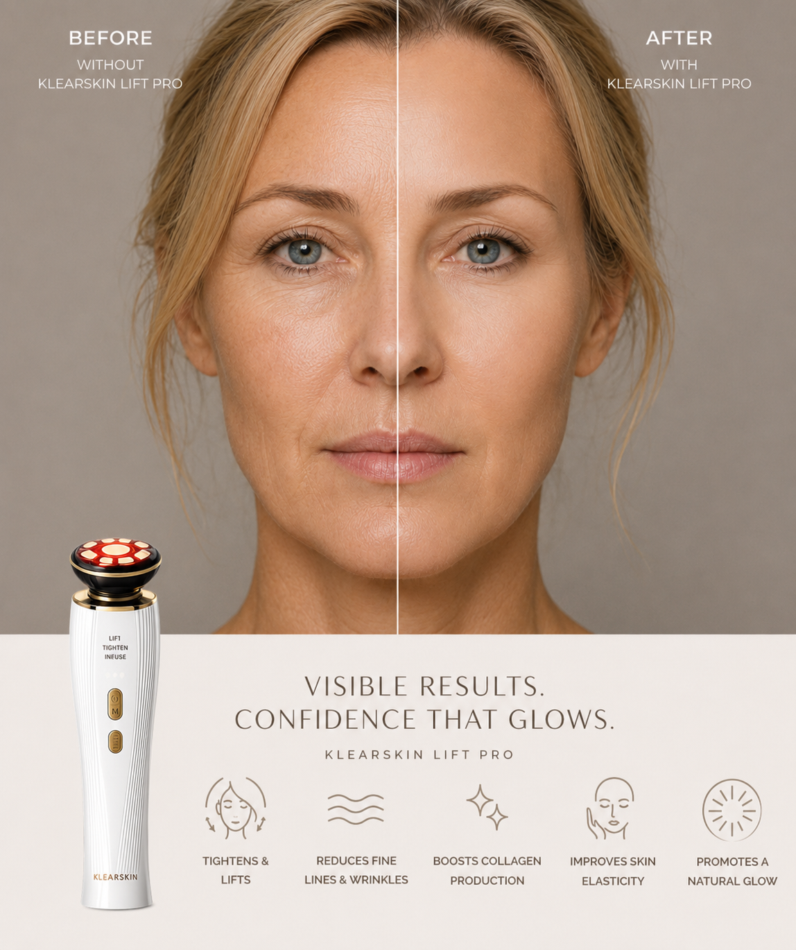 Our New KlearSkin Lift RF™